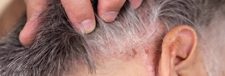 psoriasis du cuir chevelu